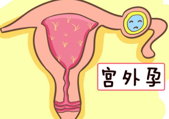 宫外孕的症状有哪些表现(宫外孕的症状有哪些表现宫外孕怎么办)