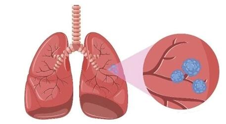 肺部有结节是怎么回事严重吗(肺部有结节是怎么回事严重吗知乎)