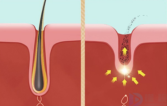 激光脱毛原理解释