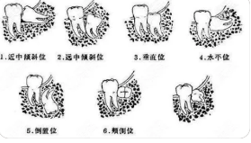 智齿到底要不要拔